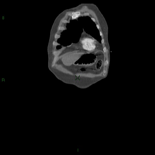 File:Abdominal aortic aneurysm rupture with aortocaval fistula (Radiopaedia 14897-14841 Coronal C+ arterial phase 13).jpg