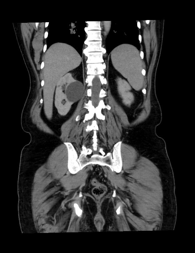 Abdominal lymphoma - with sandwich sign (Radiopaedia 53486-59492 C+ portal venous phase 13).jpg