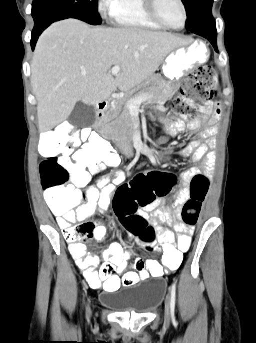 Abdominal wall and retroperitoneal tuberculosis (Radiopaedia 88137-104729 Coronal C+ portal venous phase 34).jpg