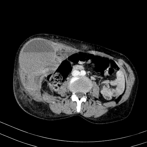 Abdominal wall hematoma with active bleeding (Radiopaedia 83915-99122 Axial contrast-enhanced CT 27).jpg