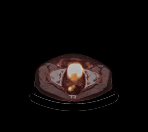 Abdominal wall metastasis from colorectal carcinoma (Radiopaedia 31016-31719 C 27).jpg