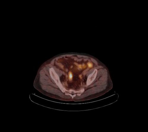 Abdominal wall metastasis from colorectal carcinoma (Radiopaedia 31016-31719 C 35).jpg