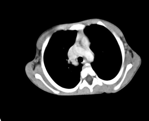 Abdominopelvic rhabdomyosarcoma (Radiopaedia 78356-90984 Axial C+ portal venous phase 12).jpg
