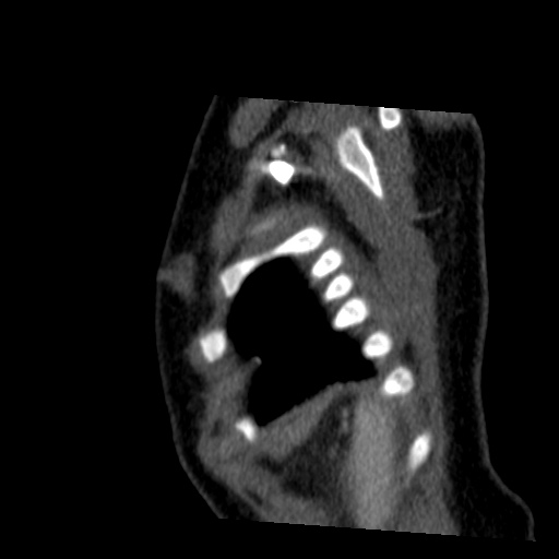 File:Aberrant left pulmonary artery (pulmonary sling) (Radiopaedia 42323-45435 Sagittal C+ arterial phase 52).jpg