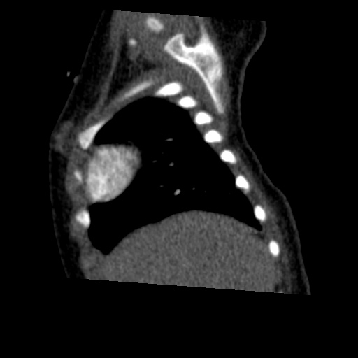 Aberrant left pulmonary artery (pulmonary sling) (Radiopaedia 42323-45435 Sagittal C+ arterial phase 8).jpg