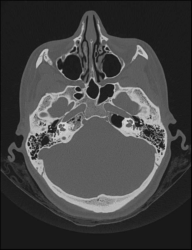 Aberrant right internal carotid artery (Radiopaedia 65191-74198 Axial non-contrast 43).jpg