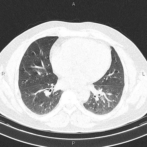 Aberrant right subclavian artery (Radiopaedia 87093-103354 Axial lung window 67).jpg