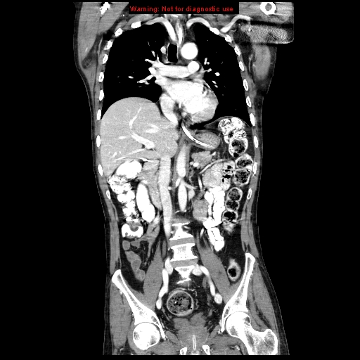 File:Aberrant right subclavian artery (Radiopaedia 9379-10071 Coronal C+ arterial phase 11).jpg