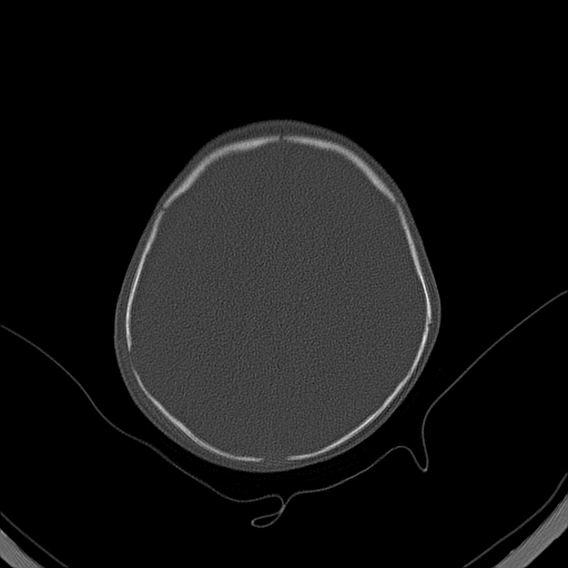 File:Accessory intraparietal suture (Radiopaedia 50584-56020 Axial bone window 32).jpg