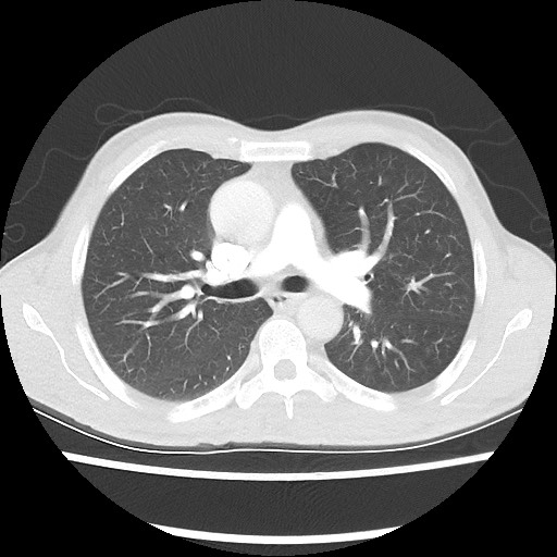 Accessory left horizontal fissure with lingular pneumonia (Radiopaedia 53763-59843 Axial lung window 25).jpg