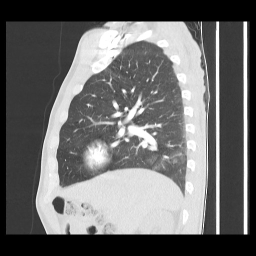 File:Accessory left horizontal fissure with lingular pneumonia (Radiopaedia 53763-59843 Sagittal lung window 25).jpg