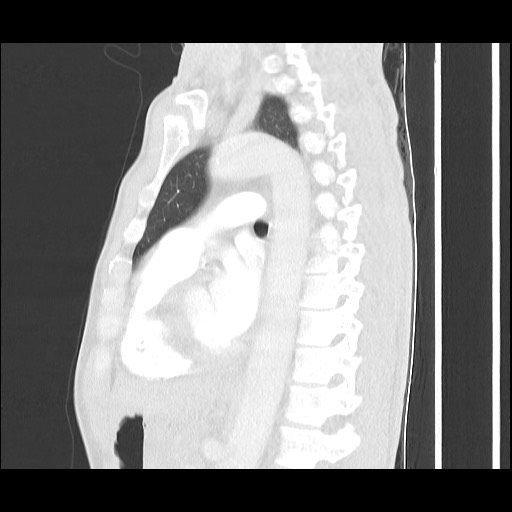 Accessory left horizontal fissure with lingular pneumonia (Radiopaedia 53763-59843 Sagittal lung window 40).jpg