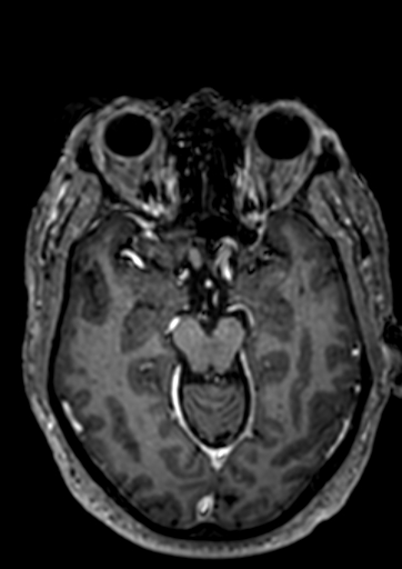 Accessory middle cerebral artery (Radiopaedia 73114-83828 Axial T1 C+ 78).jpg