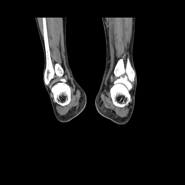 Accessory soleus muscle (Radiopaedia 61069-68943 Coronal non-contrast 53).jpg