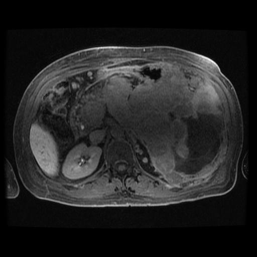 Acinar cell carcinoma of the pancreas (Radiopaedia 75442-86668 Axial late phase (~30 mins) 59).jpg