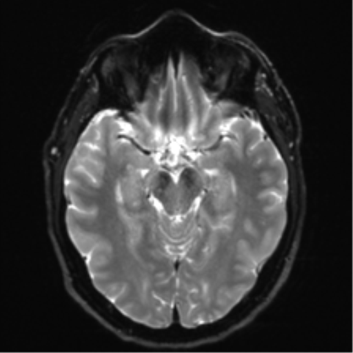 File:Acoustic schwannoma (Radiopaedia 50846-56358 Axial DWI 12).png