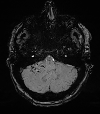 Acoustic schwannoma (Radiopaedia 50846-56358 Axial SWI 19).png