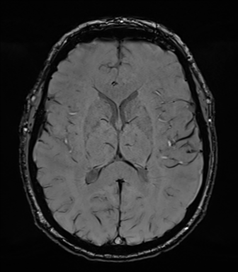Acoustic schwannoma (Radiopaedia 50846-56358 Axial SWI 52).png
