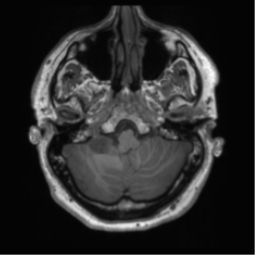 File:Acoustic schwannoma (Radiopaedia 50846-56358 Axial T1 10).png