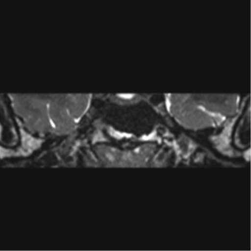File:Acoustic schwannoma (Radiopaedia 50846-56358 Coronal T2 36).png