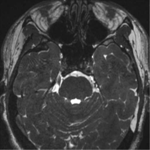 Acoustic schwannoma (translabyrinthine resection) (Radiopaedia 43570-46972 Axial CISS 44).png