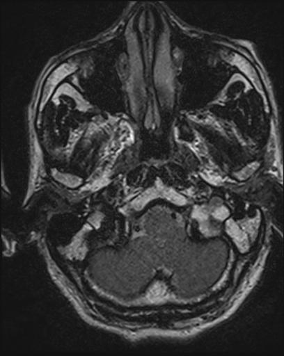 Acoustic schwannoma - probable (Radiopaedia 20386-20292 Axial T1 20).jpg