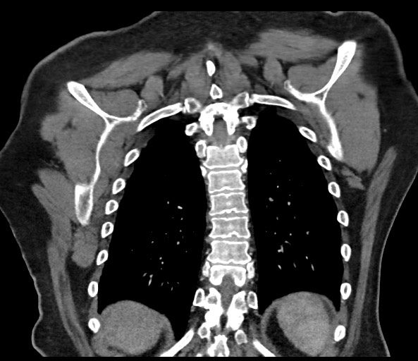 File:Acromioclavicular joint cyst (Radiopaedia 58455-65610 Coronal 70).jpg