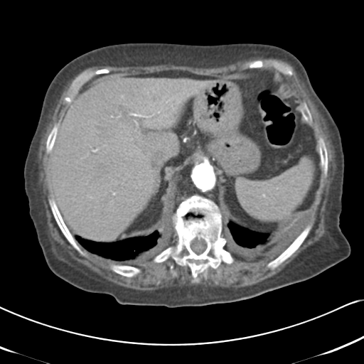 File:Active bleeding from duodenal ulcer with embolization (Radiopaedia 34216-35481 Axial C+ arterial phase 16).png