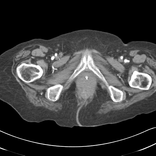 File:Active bleeding from duodenal ulcer with embolization (Radiopaedia 34216-35481 Axial C+ arterial phase 72).png