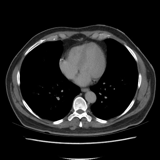 File:Active colonic bleed on CT (Radiopaedia 49765-55025 Axial C+ delayed 2).jpg