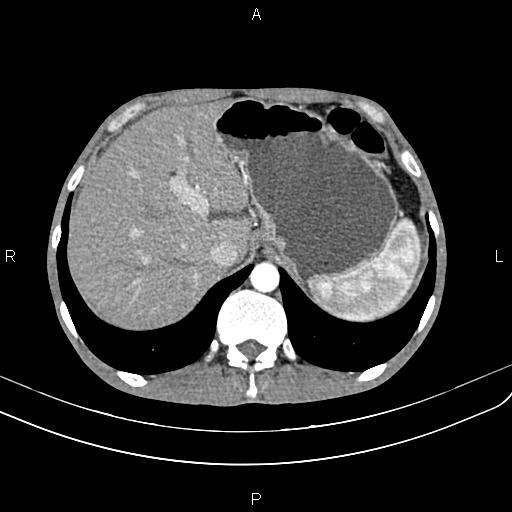 Active crohn disease (Radiopaedia 87133-103397 Axial C+ arterial phase 22).jpg