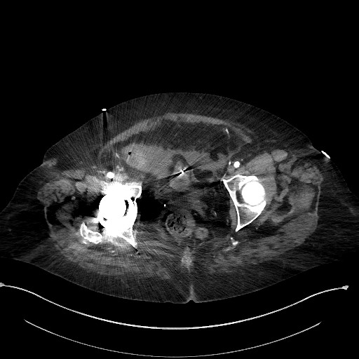 Active renal extravasation with large subcapsular and retroperitoneal hemorrhage (Radiopaedia 60975-68796 Axial C+ arterial phase 183).jpg