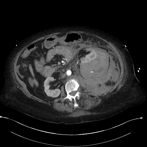 Active renal extravasation with large subcapsular and retroperitoneal hemorrhage (Radiopaedia 60975-68796 Axial C+ arterial phase 85).jpg