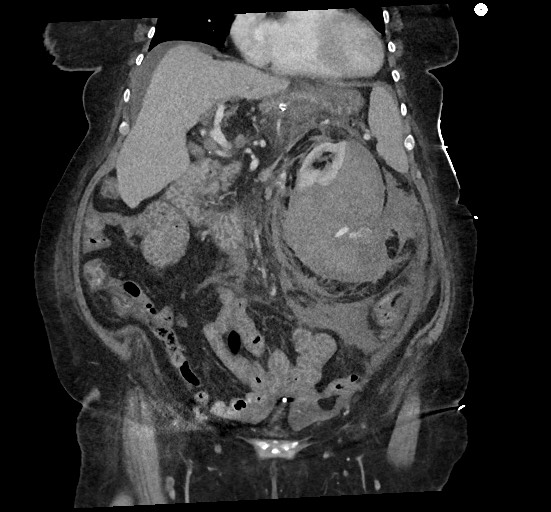 File:Active renal extravasation with large subcapsular and retroperitoneal hemorrhage (Radiopaedia 60975-68796 Coronal C+ portal venous phase 67).jpg