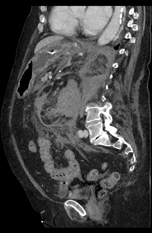 Active renal extravasation with large subcapsular and retroperitoneal hemorrhage (Radiopaedia 60975-68796 Sagittal C+ portal venous phase 106).jpg