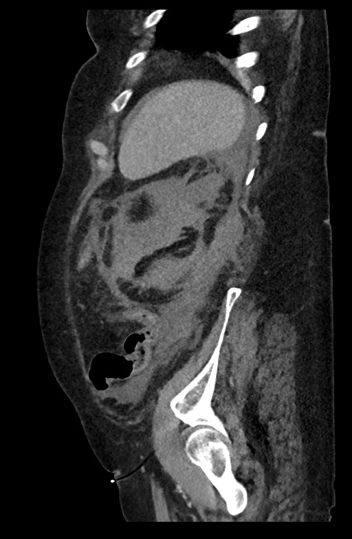 Active renal extravasation with large subcapsular and retroperitoneal hemorrhage (Radiopaedia 60975-68796 Sagittal C+ portal venous phase 63).jpg