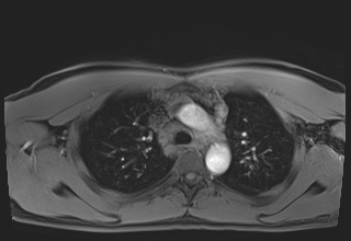 Active right ventricular cardiac sarcoidosis (Radiopaedia 55596-62100 Axial Post contrast Dixon 15).jpg