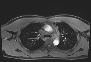 Active right ventricular cardiac sarcoidosis (Radiopaedia 55596-62100 Axial Post contrast Dixon 18).jpg