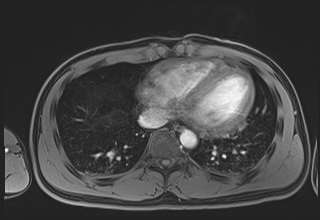 File:Active right ventricular cardiac sarcoidosis (Radiopaedia 55596-62100 Axial Post contrast Dixon 55).jpg