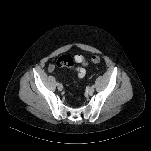Acute-on-chronic pancreatitis (Radiopaedia 67286-76656 Axial C+ portal venous phase 65).jpg