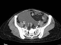 Acute Budd-Chiari syndrome (Radiopaedia 60858-68638 A 234).jpg