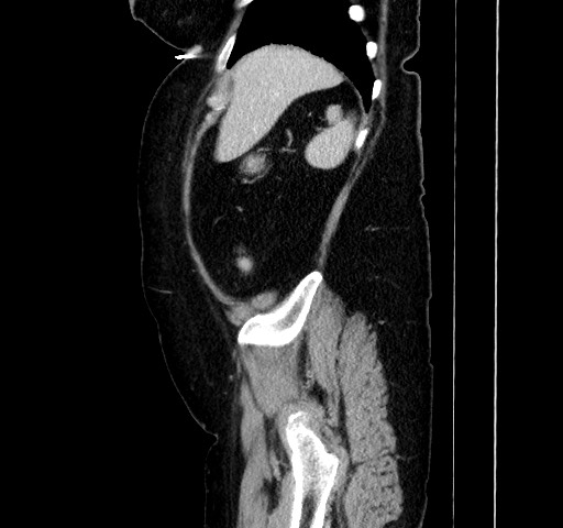 Acute appendicitis, heterotaxy syndrome (Radiopaedia 66884-76202 Sagittal C+ portal venous phase 31).jpg