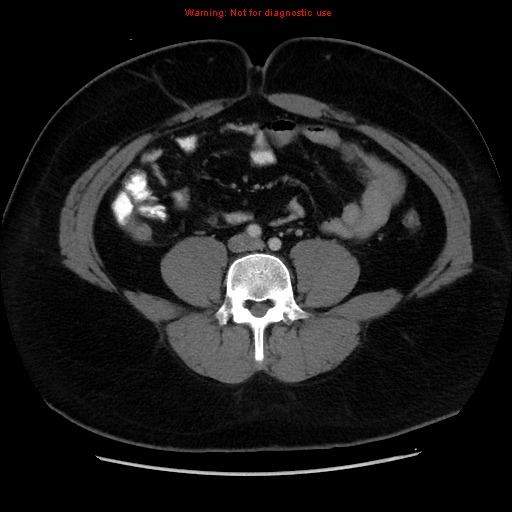 File:Acute appendicitis (Radiopaedia 12326-12607 Axial C+ portal venous phase 14).jpg