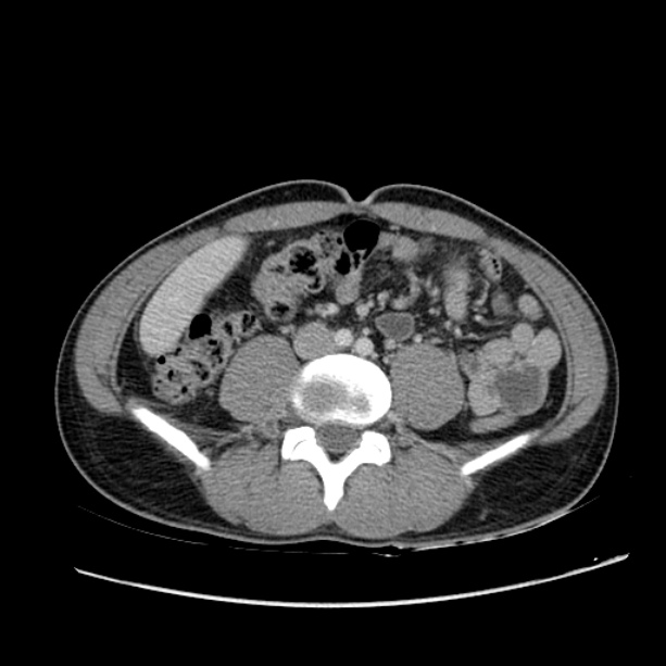 Acute appendicitis (Radiopaedia 27049-27227 Axial C+ portal venous phase 43).jpg