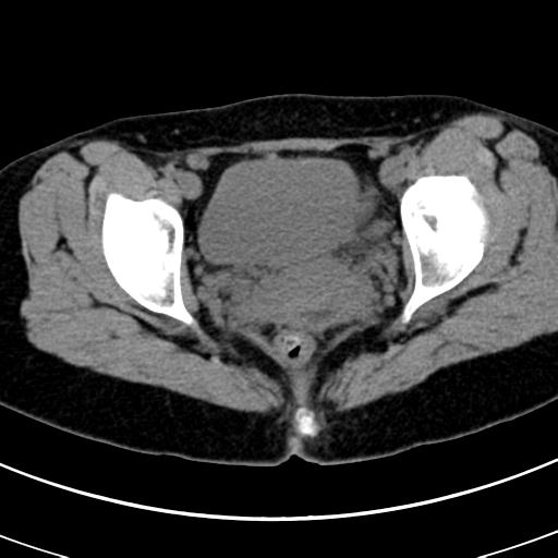 Acute appendicitis (Radiopaedia 30261-30888 Axial non-contrast 100).jpg