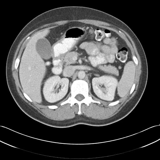 File:Acute appendicitis (Radiopaedia 30297-30934 Axial C+ portal venous phase 26).jpg
