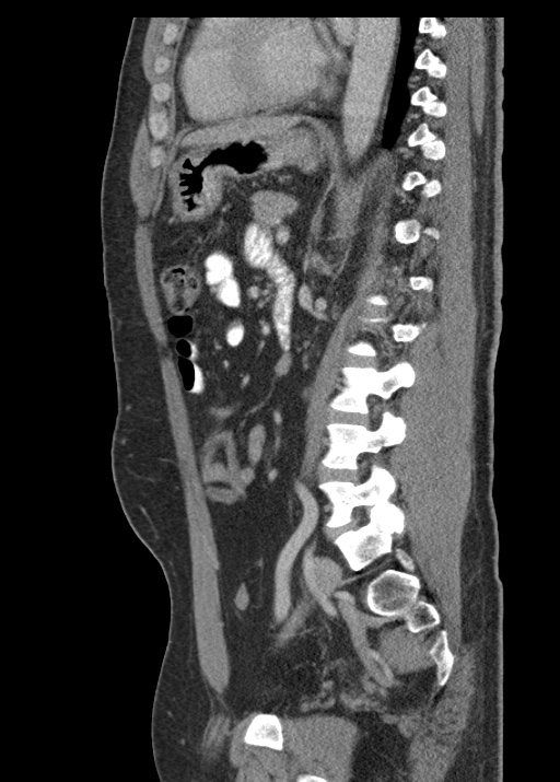 Acute appendicitis (Radiopaedia 48511-53463 Sagittal C+ portal venous phase 81).jpg