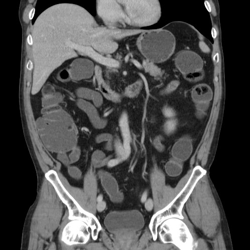 Acute appendicitis (Radiopaedia 66513-75790 Coronal C+ portal venous phase 35).jpg