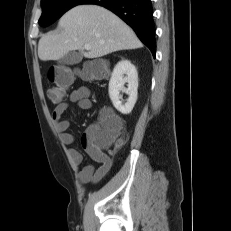 Acute appendicitis (Radiopaedia 66513-75790 Sagittal C+ portal venous phase 40).jpg
