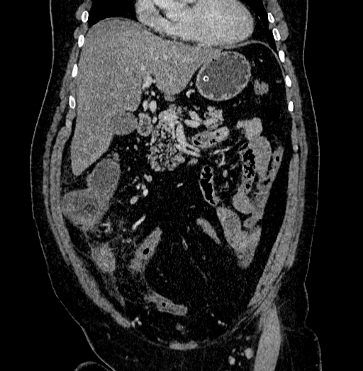 Acute appendicitis (Radiopaedia 79950-93224 Coronal C+ portal venous phase 34).jpg